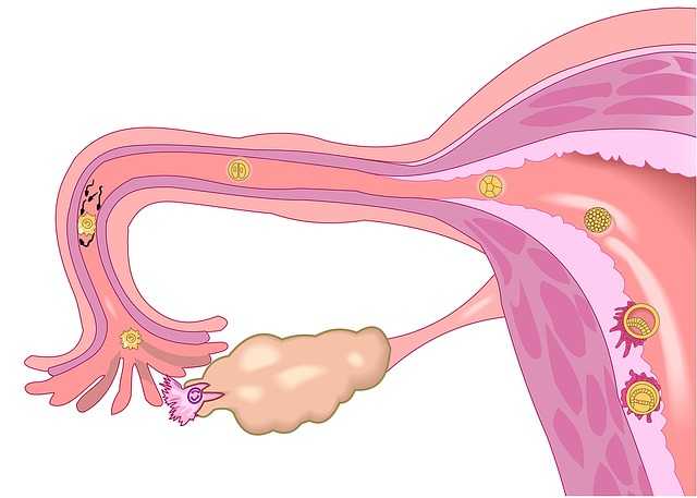 Hiperplasia endometrial 1